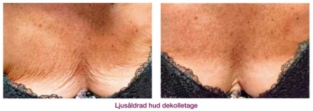 Kemisk peeling Uppsala