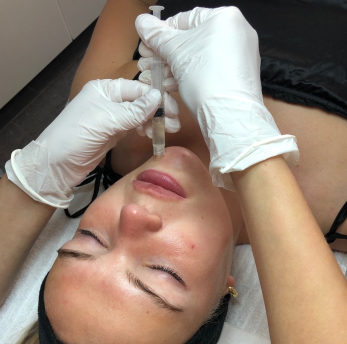 Kemisk peeling Uppsala