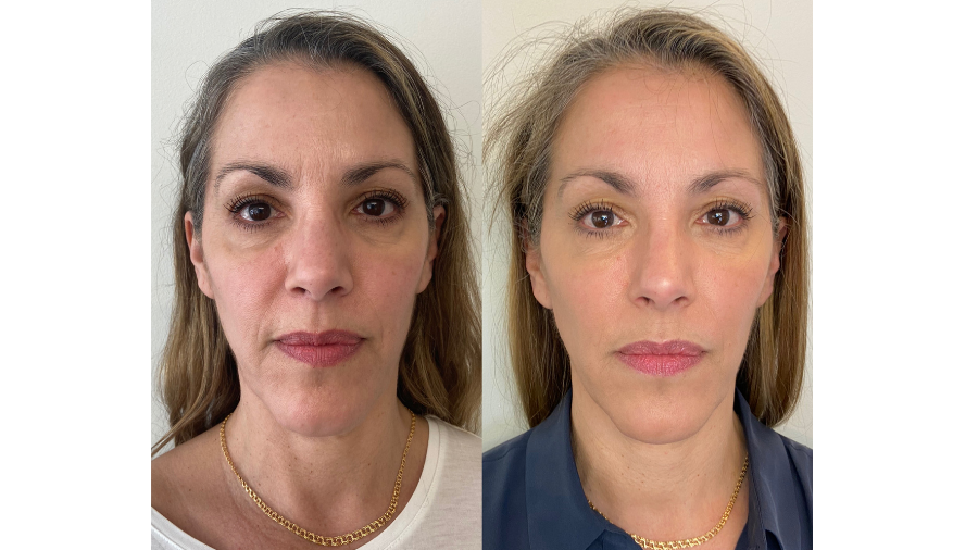 Fillers Uppsala