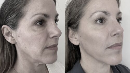 Fillers Uppsala Skönhetsbehandlingar