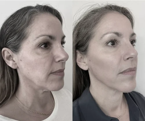 Fillers Uppsala Skönhetsbehandlingar